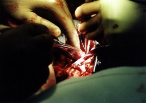 open_heart_surgery_3